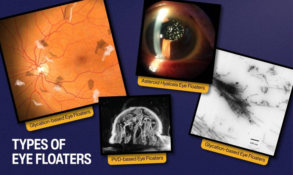 Types of eye floaters
